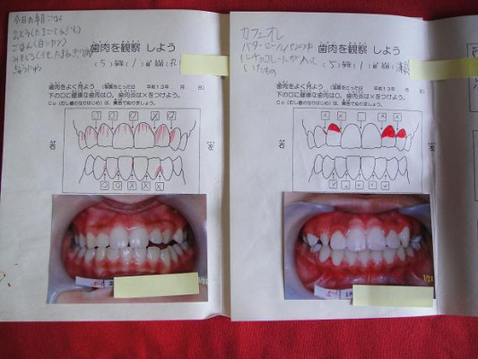 小学校口腔写真