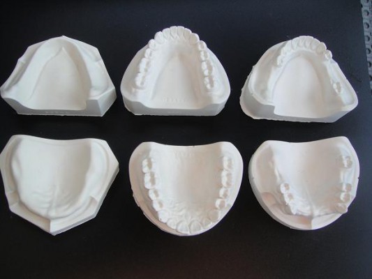 石膏顎模型