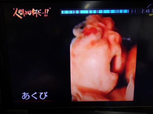 胎児あくび